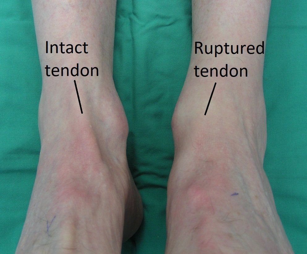 Tibialis Anterior Tendonitis Tendinopathy Symptoms Causes Treatment